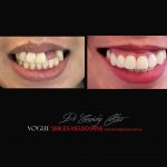 Top Cosmetic Dentist in Melbourne CBD before and after photo case study r33