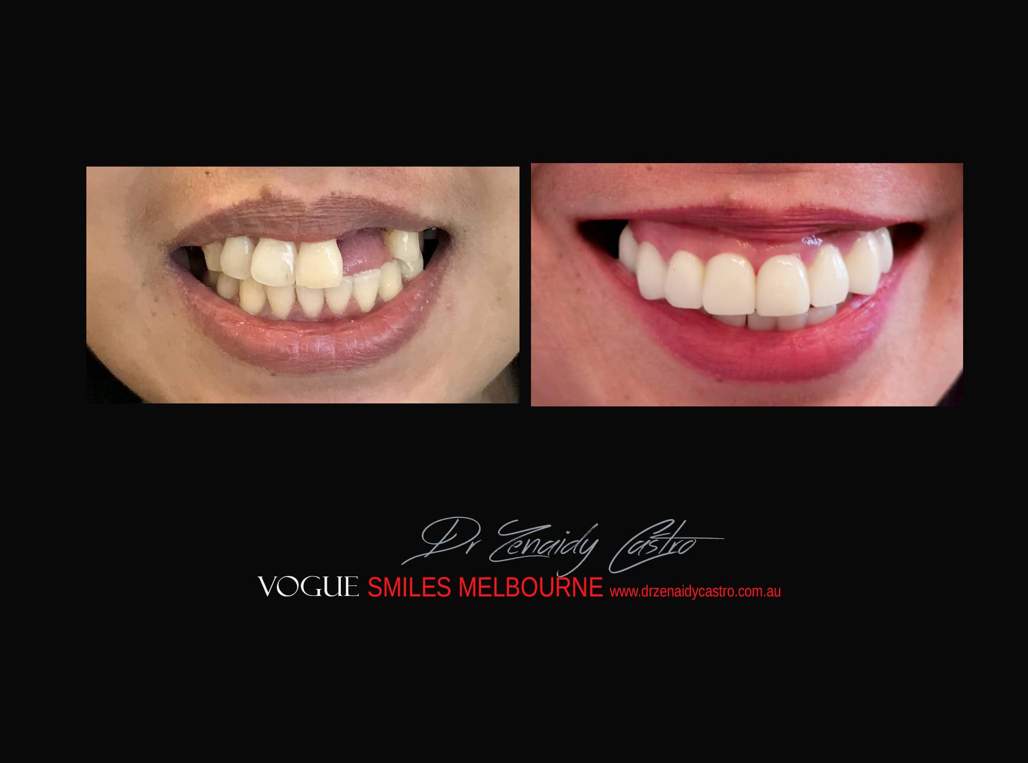 Top Cosmetic Dentist in Melbourne CBD before and after photo case study r33