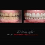 Top Cosmetic Dentist in Melbourne CBD before and after photo case study r32