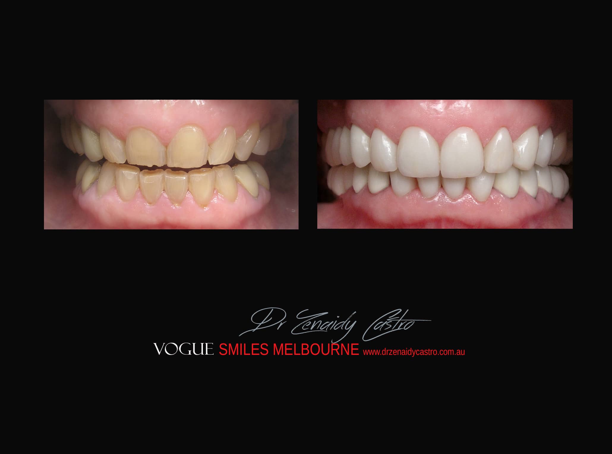 Top Cosmetic Dentist in Melbourne CBD before and after photo case study r32