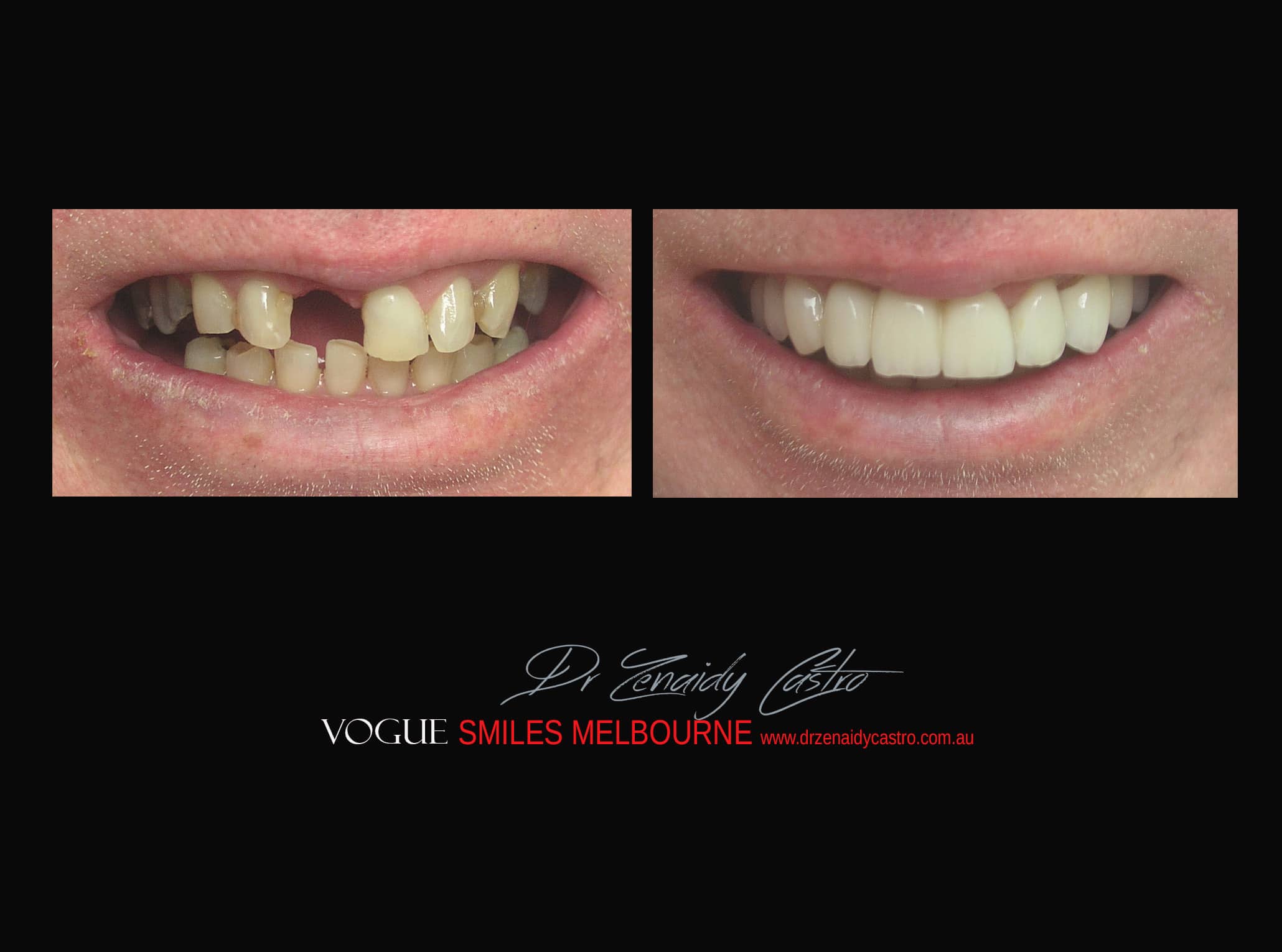Top Cosmetic Dentist in Melbourne CBD before and after photo case study r31