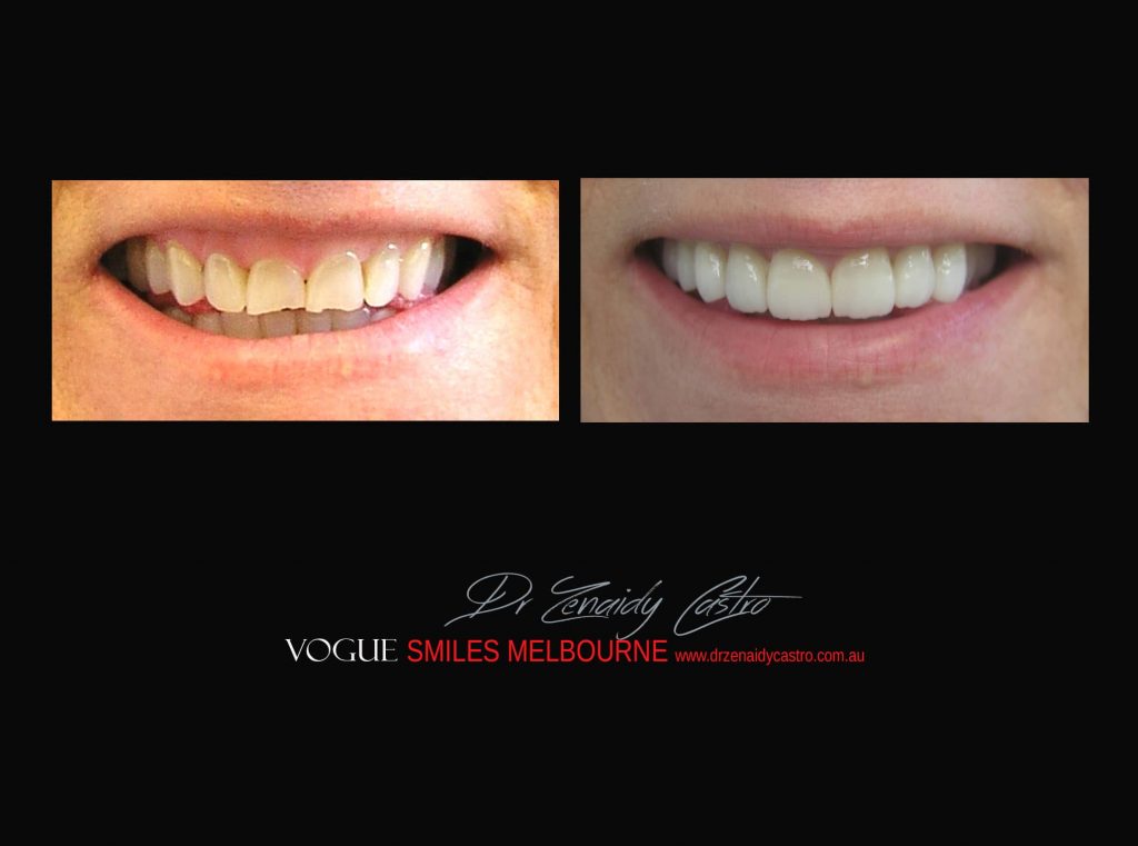 Top Cosmetic Dentist in Melbourne CBD before and after photo case study r30