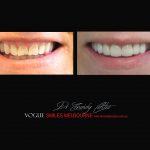 Top Cosmetic Dentist in Melbourne CBD before and after photo case study r30