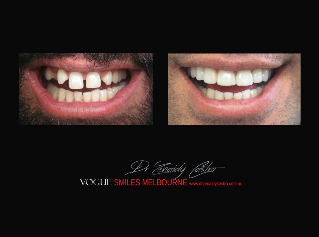 COSMETIC DENTIST MELBOURNE CASE STUDIES OF BEFORE AND AFTER- Top Cosmetic Dentist in Melbourne