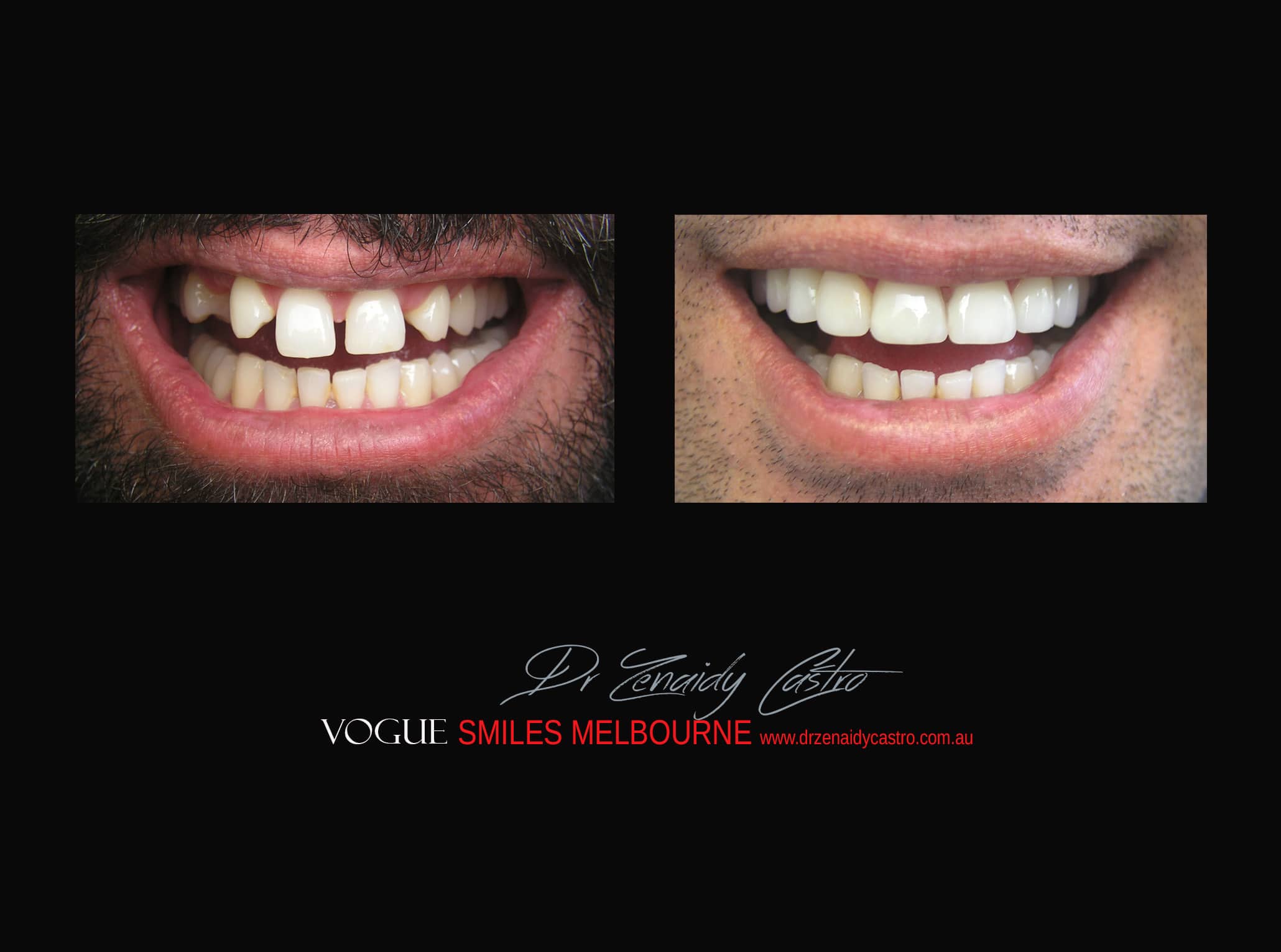 Top Cosmetic Dentist in Melbourne CBD before and after photo case study r29