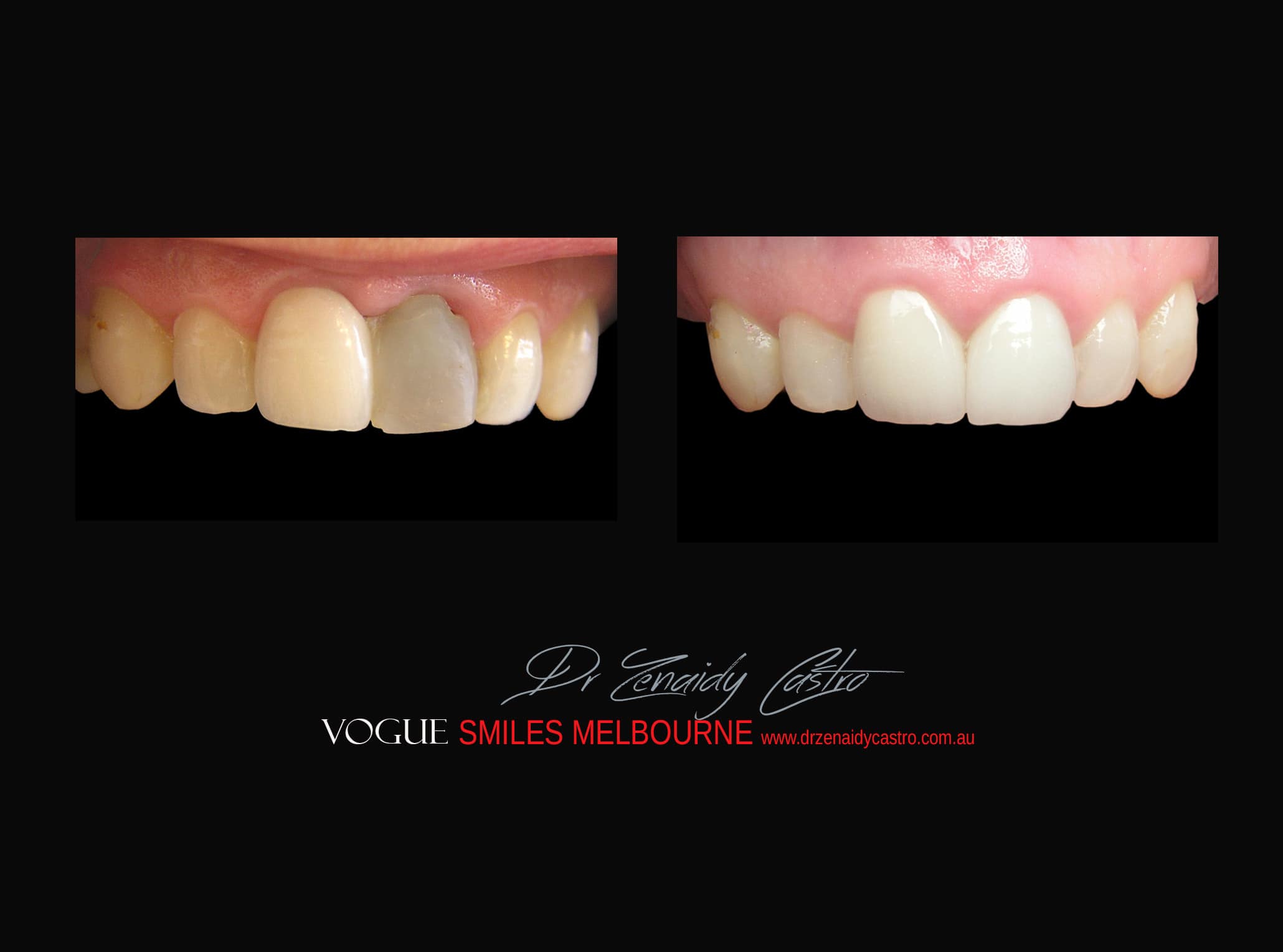 Top Cosmetic Dentist in Melbourne CBD before and after photo case study r28