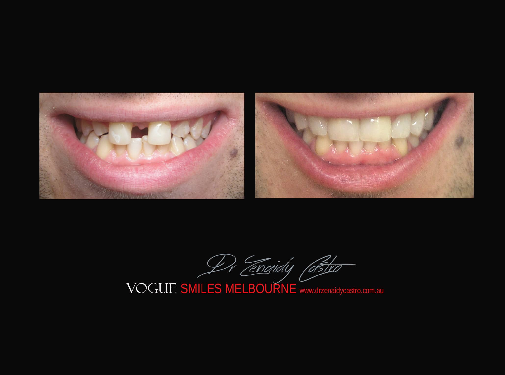 Top Cosmetic Dentist in Melbourne CBD before and after photo case study r27