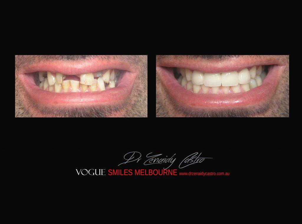 COSMETIC DENTIST MELBOURNE CASE STUDIES OF BEFORE AND AFTER- Top Cosmetic Dentist in Melbourne