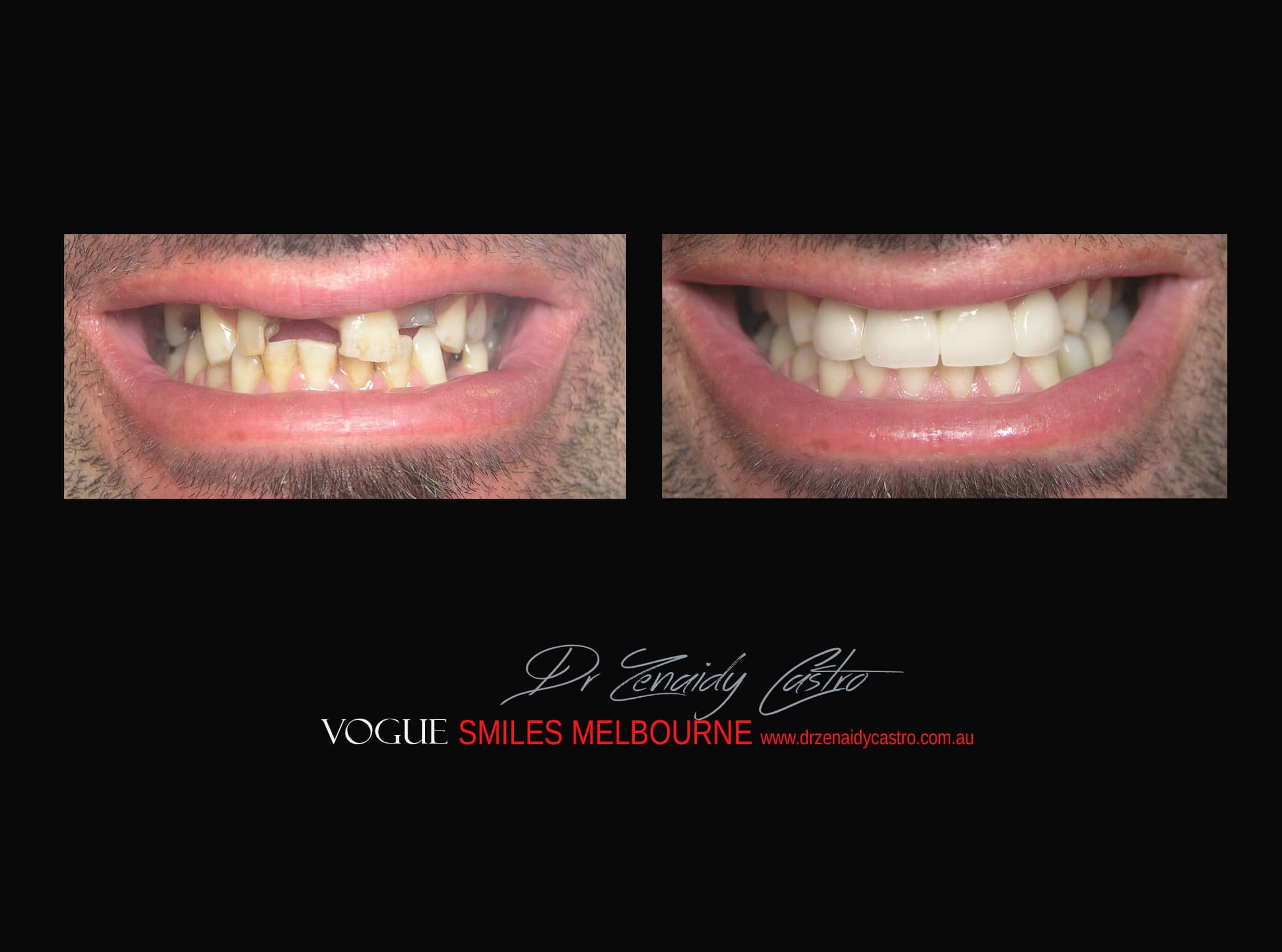 Top Cosmetic Dentist in Melbourne CBD before and after photo case study r26