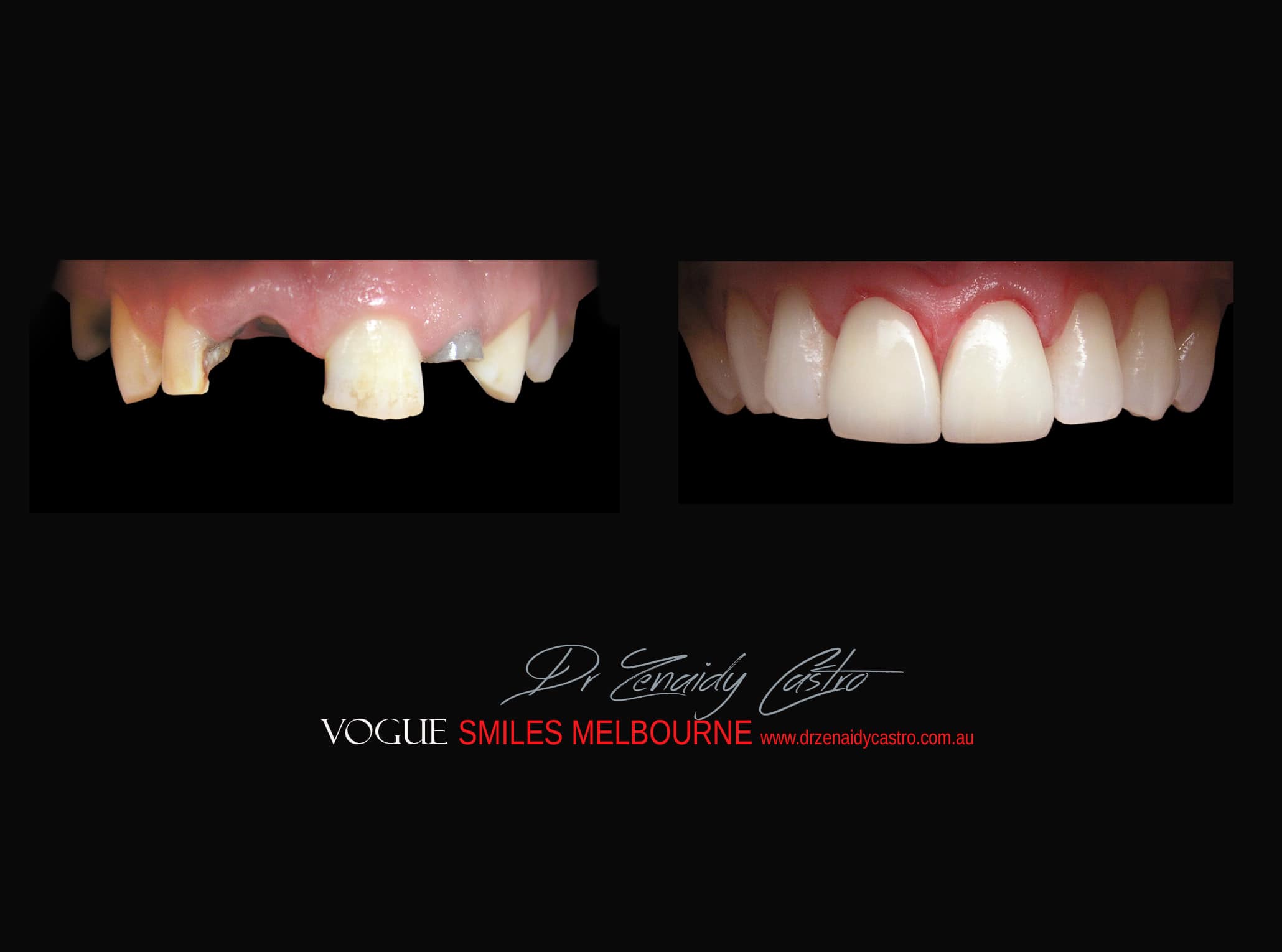 Top Cosmetic Dentist in Melbourne CBD before and after photo case study r25