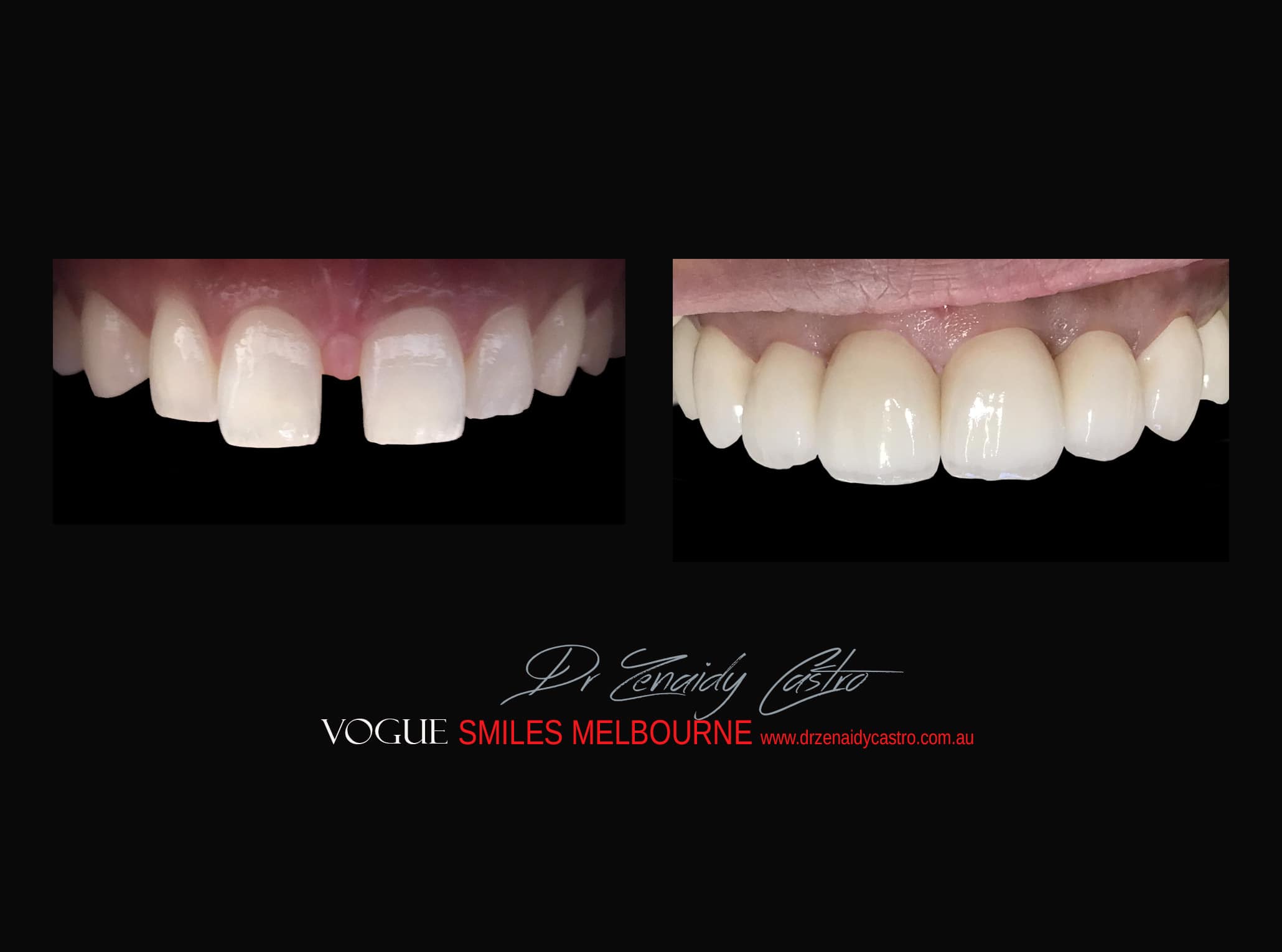 Top Cosmetic Dentist in Melbourne CBD before and after photo case study r24