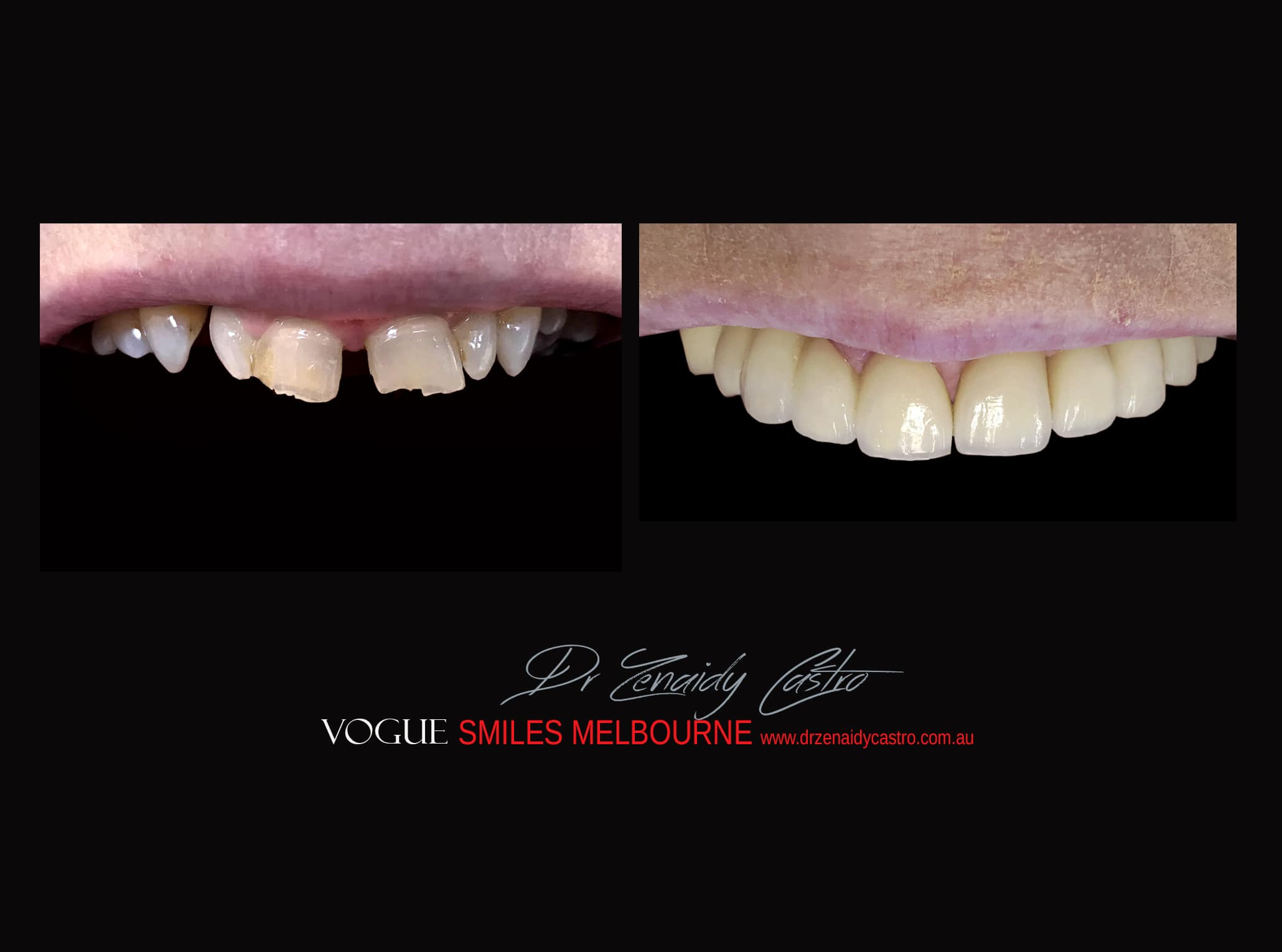 Top Cosmetic Dentist in Melbourne CBD before and after photo case study r77