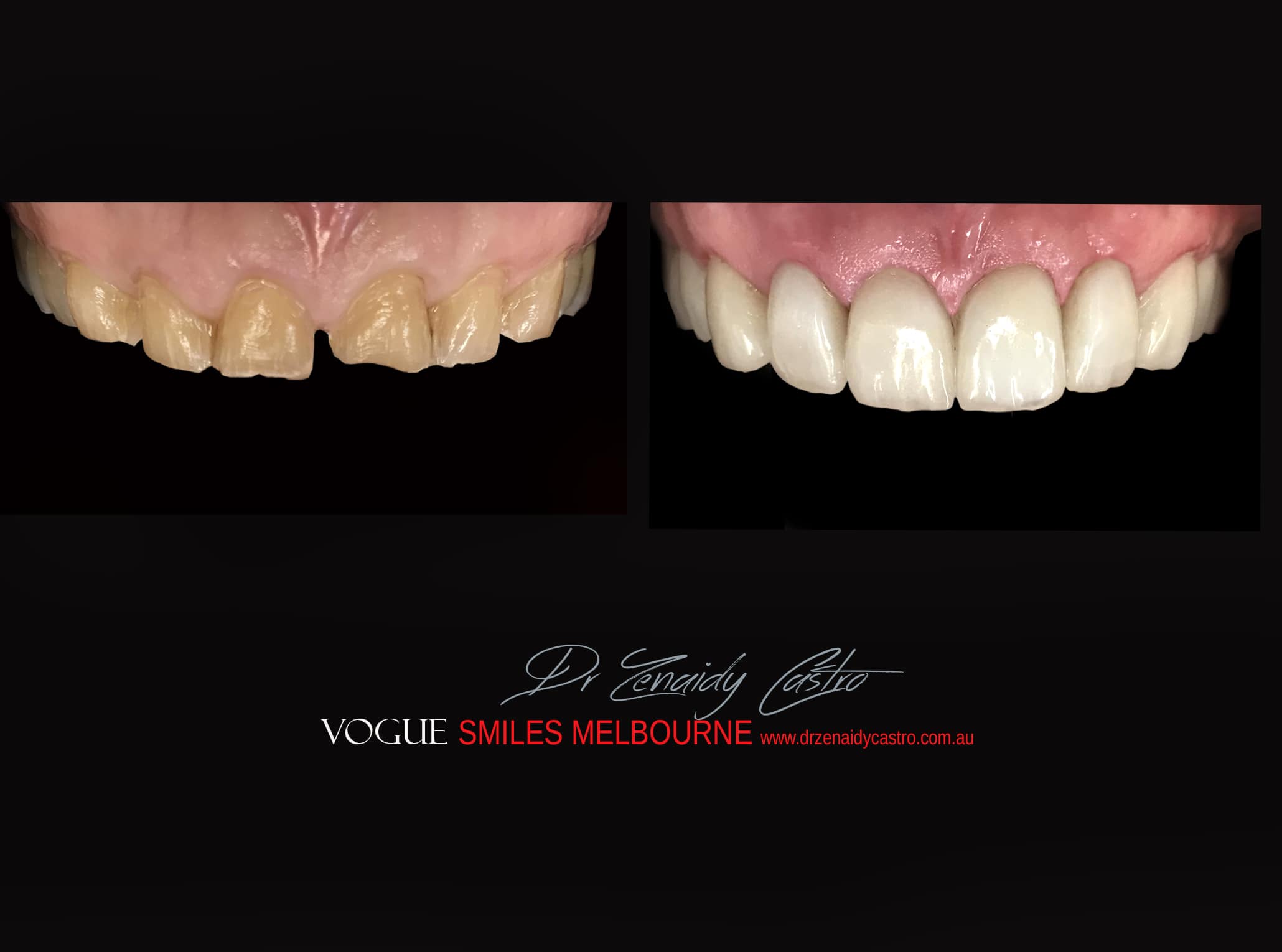 Top Cosmetic Dentist in Melbourne CBD before and after photo case study r23