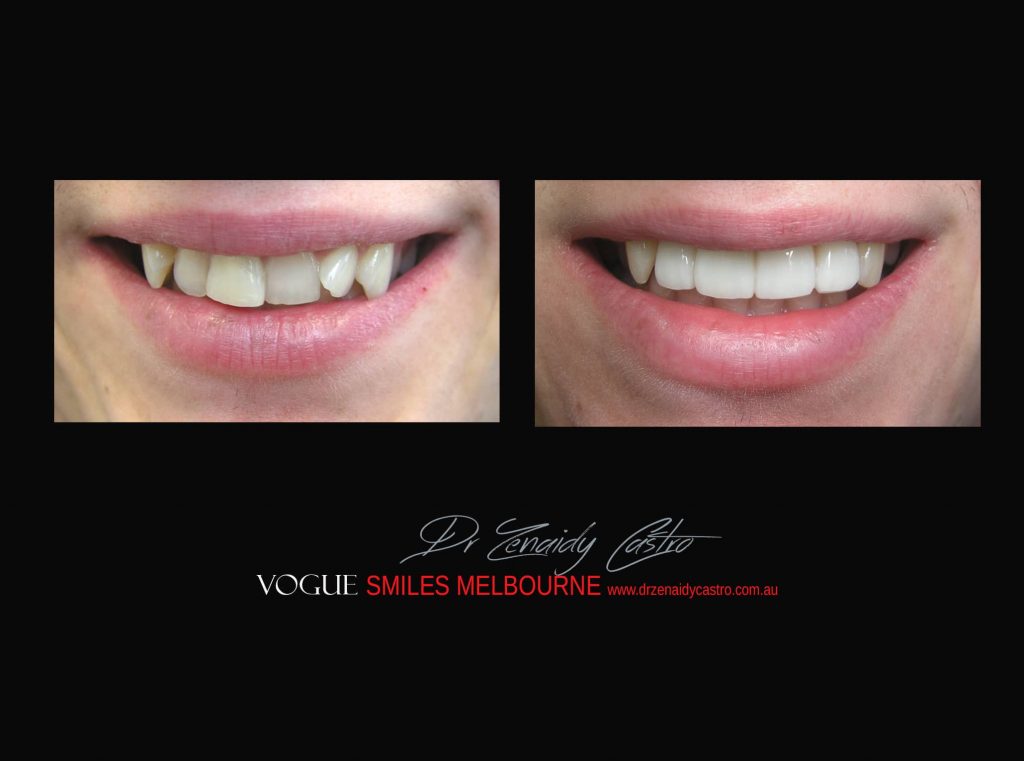 COSMETIC DENTIST MELBOURNE CASE STUDIES OF BEFORE AND AFTER- Top Cosmetic Dentist in Melbourne