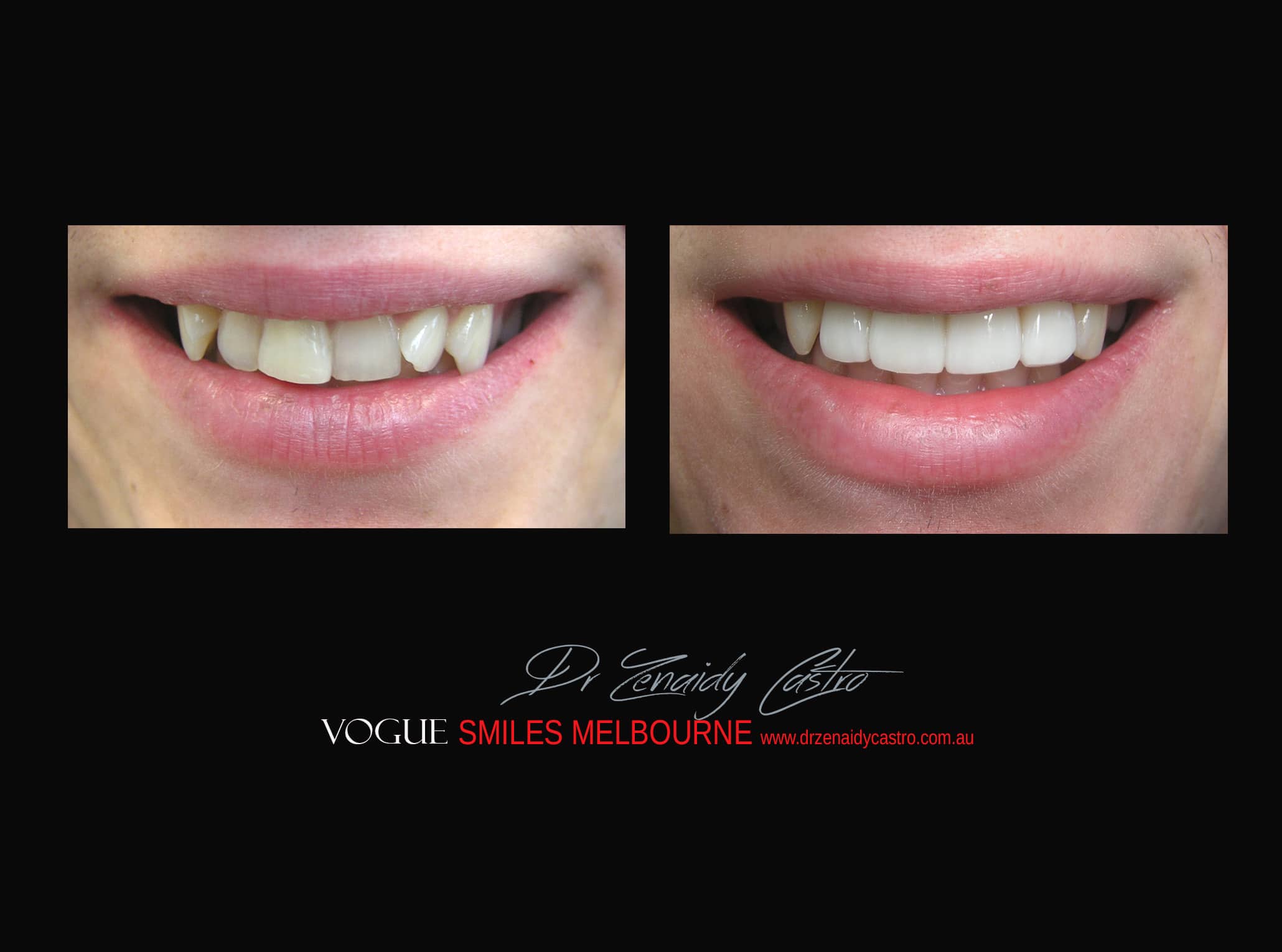 Top Cosmetic Dentist in Melbourne CBD before and after photo case study r22