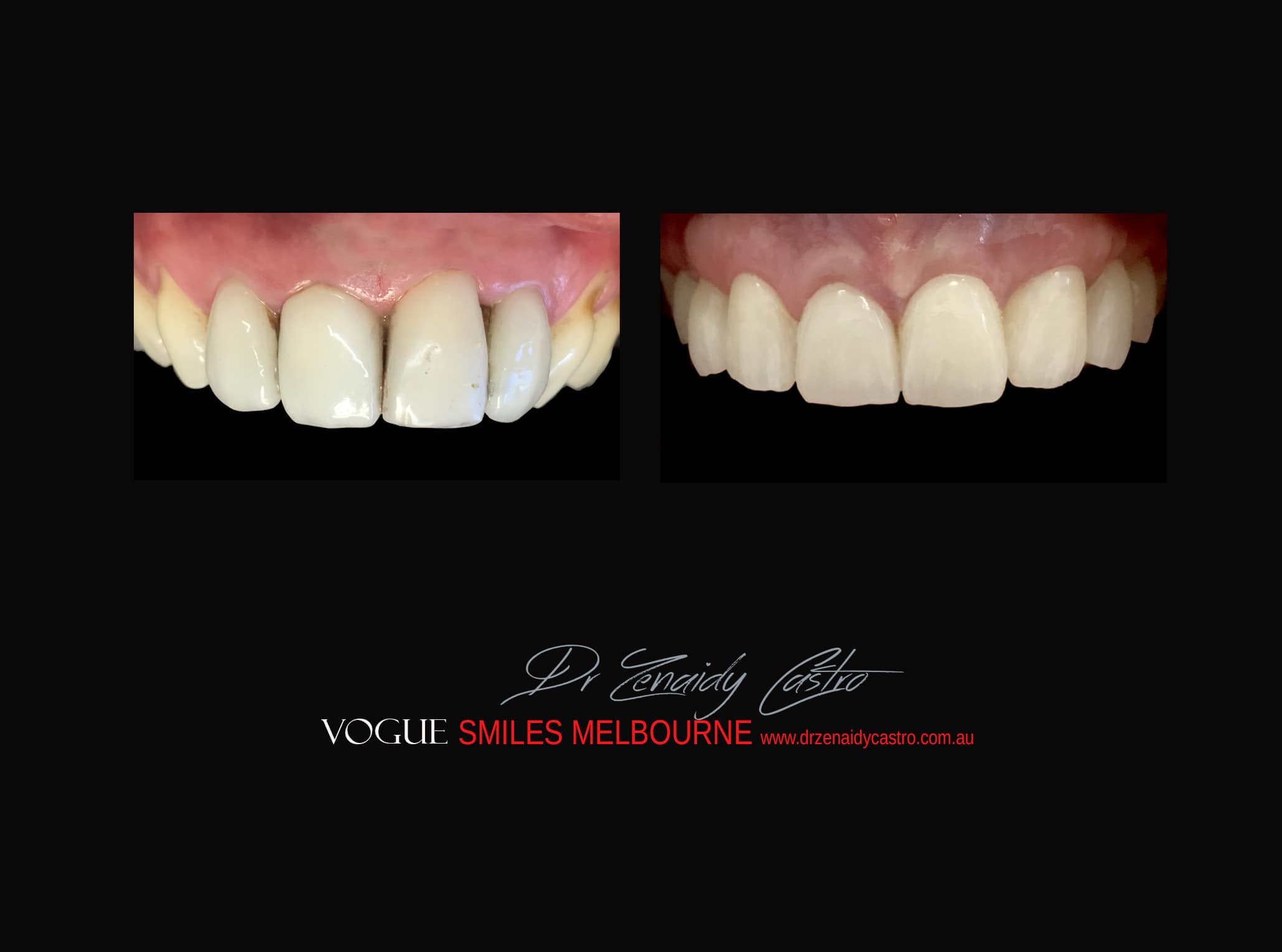 Top Cosmetic Dentist in Melbourne CBD before and after photo case study 21
