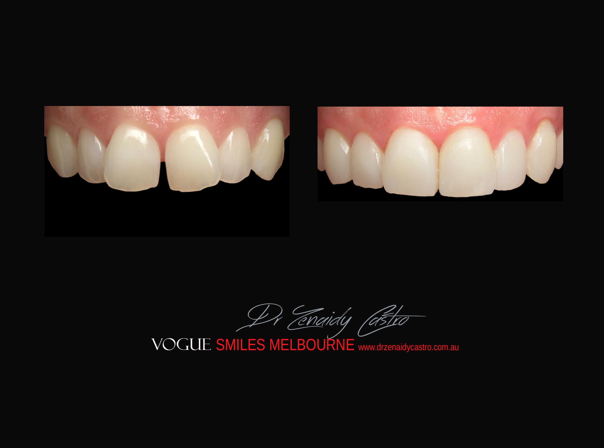 Top Cosmetic Dentist in Melbourne CBD before and after photo case study r20