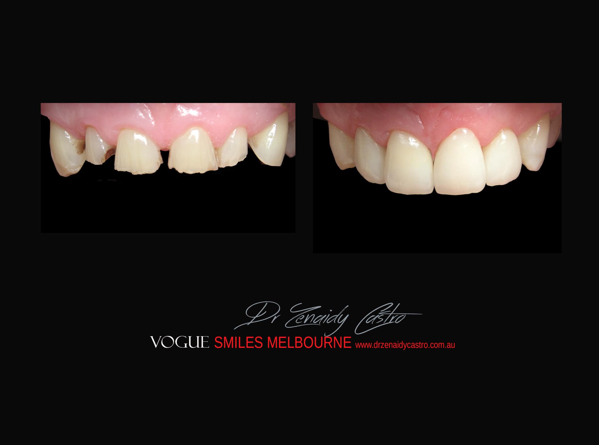 Top Cosmetic Dentist in Melbourne CBD before and after photo case study r19