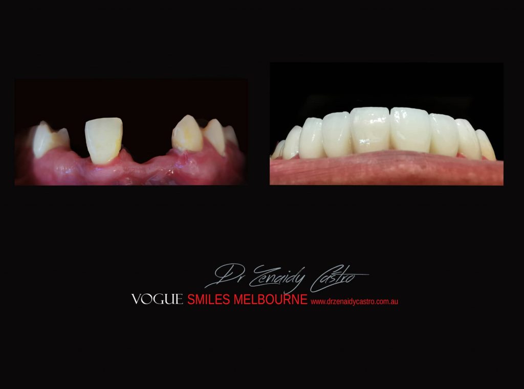 COSMETIC DENTIST MELBOURNE CASE STUDIES OF BEFORE AND AFTER- Top Cosmetic Dentist in Melbourne