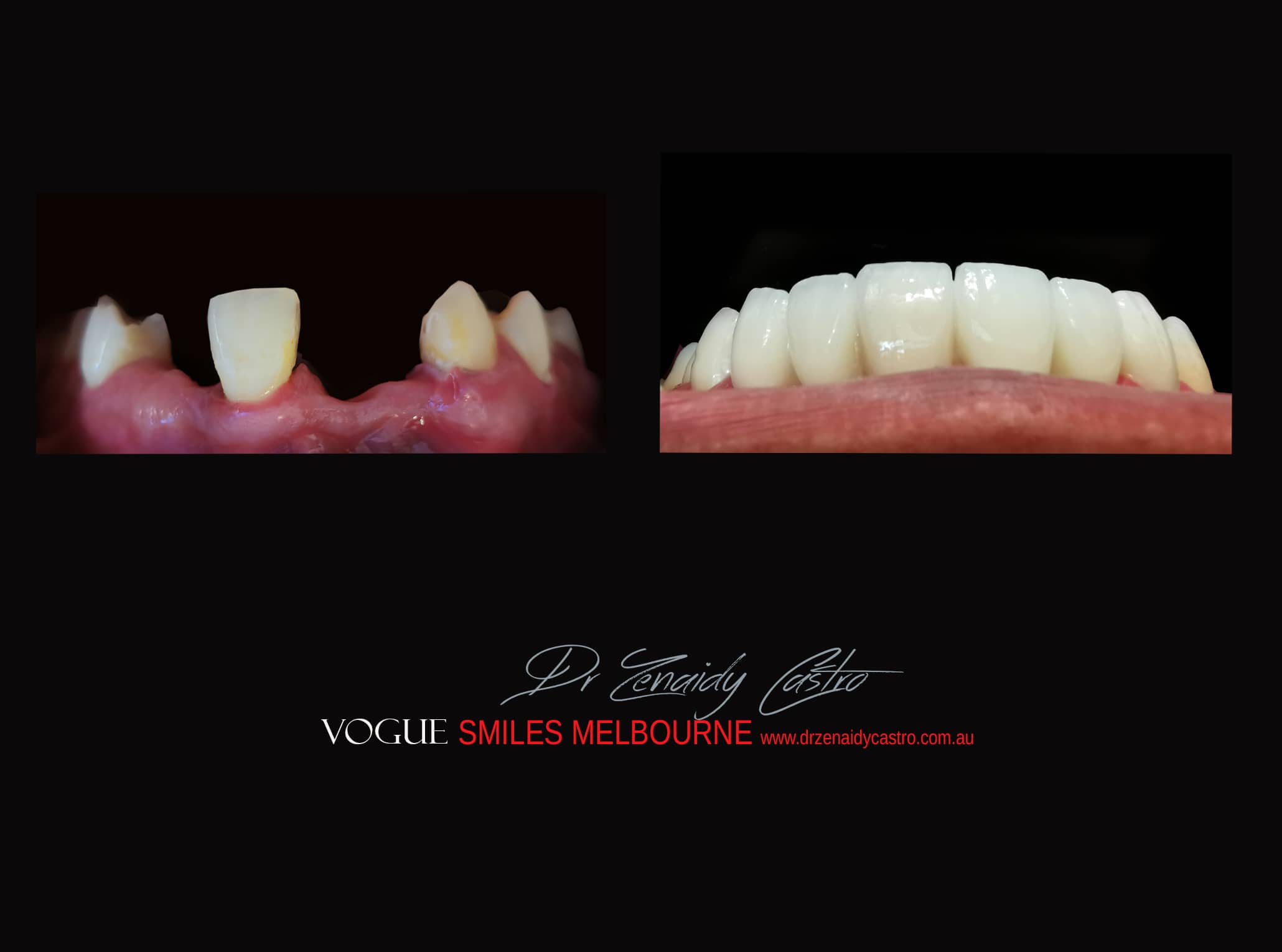 Top Cosmetic Dentist in Melbourne CBD before and after photo case study r18