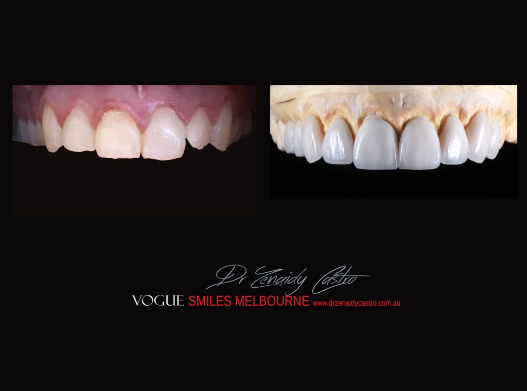 Top Cosmetic Dentist in Melbourne CBD before and after photo case study r17