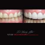 COSMETIC DENTIST MELBOURNE CASE STUDIES OF BEFORE AND AFTER- Top Cosmetic Dentist in Melbourne