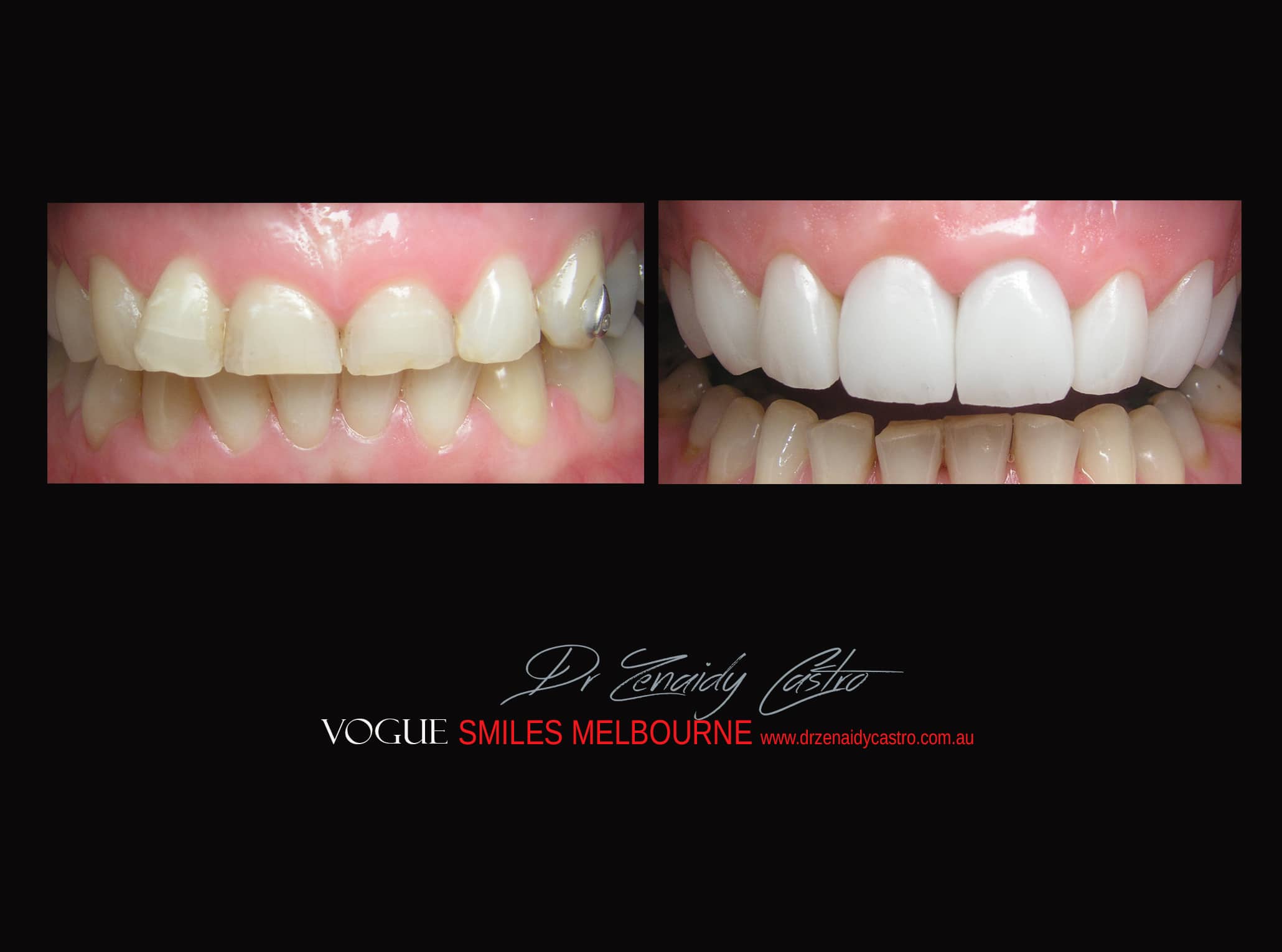 Top Cosmetic Dentist in Melbourne CBD before and after photo case study r16
