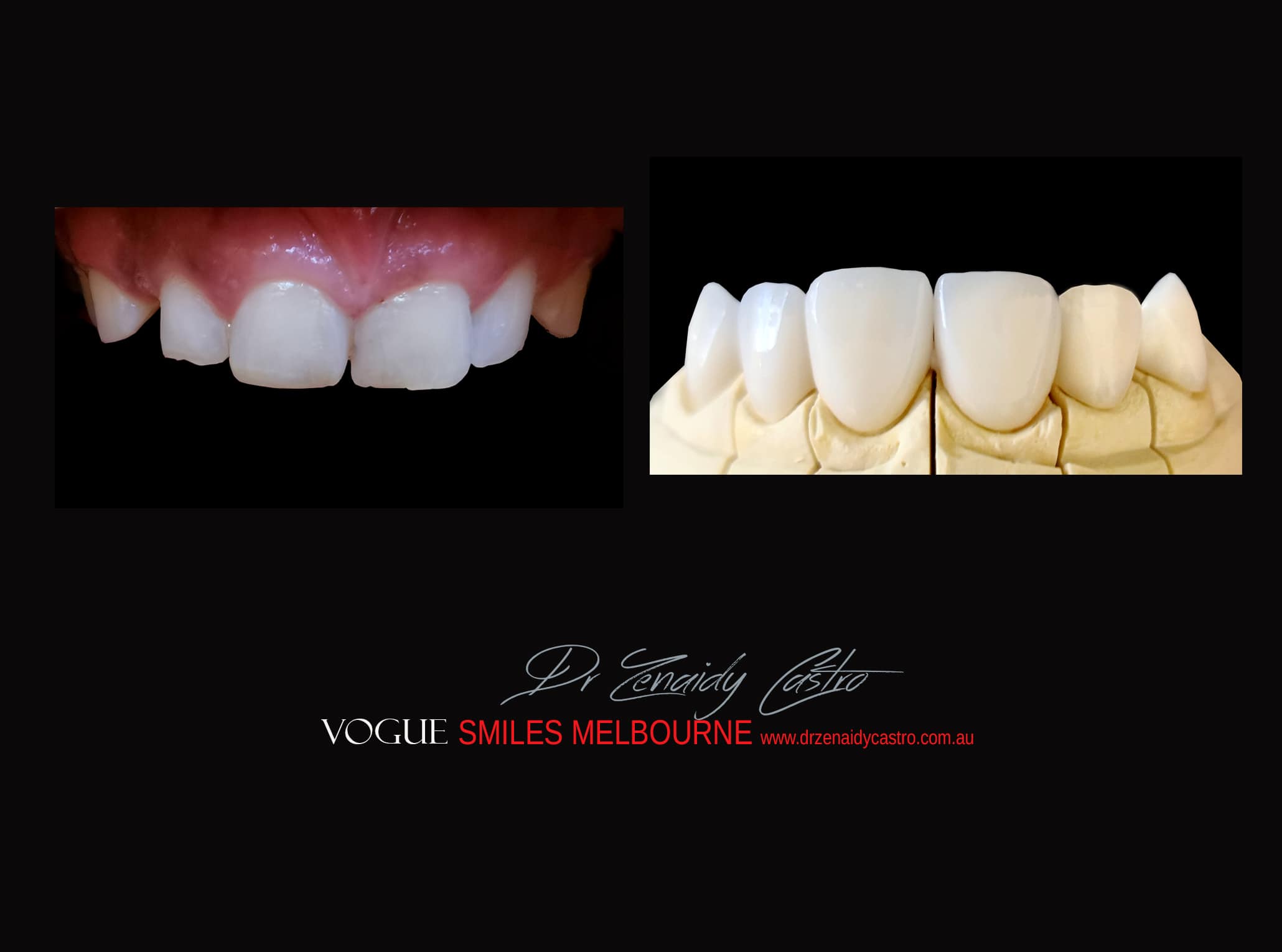 Top Cosmetic Dentist in Melbourne CBD before and after photo case study r15