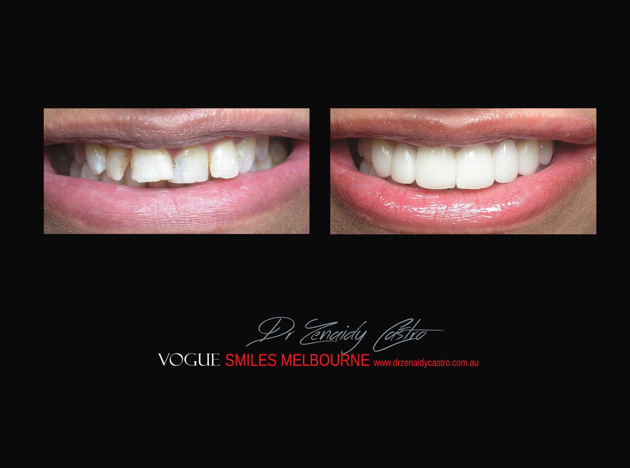 Top Cosmetic Dentist in Melbourne CBD before and after photo case study r14