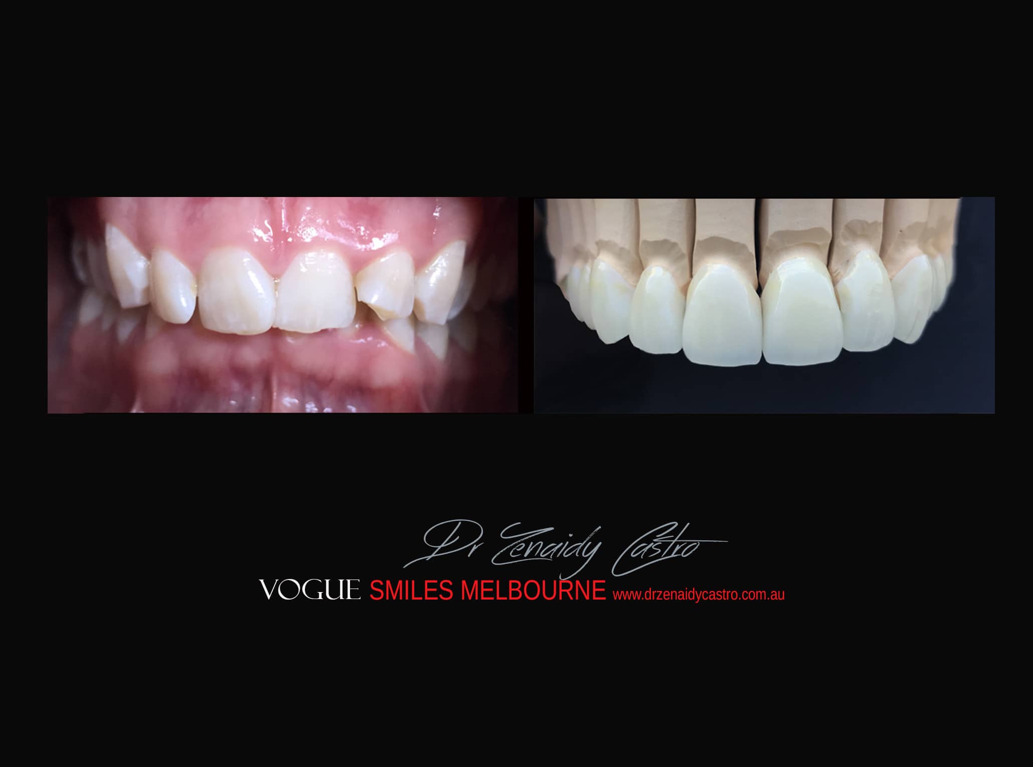 Top Cosmetic Dentist in Melbourne CBD before and after photo case study r76