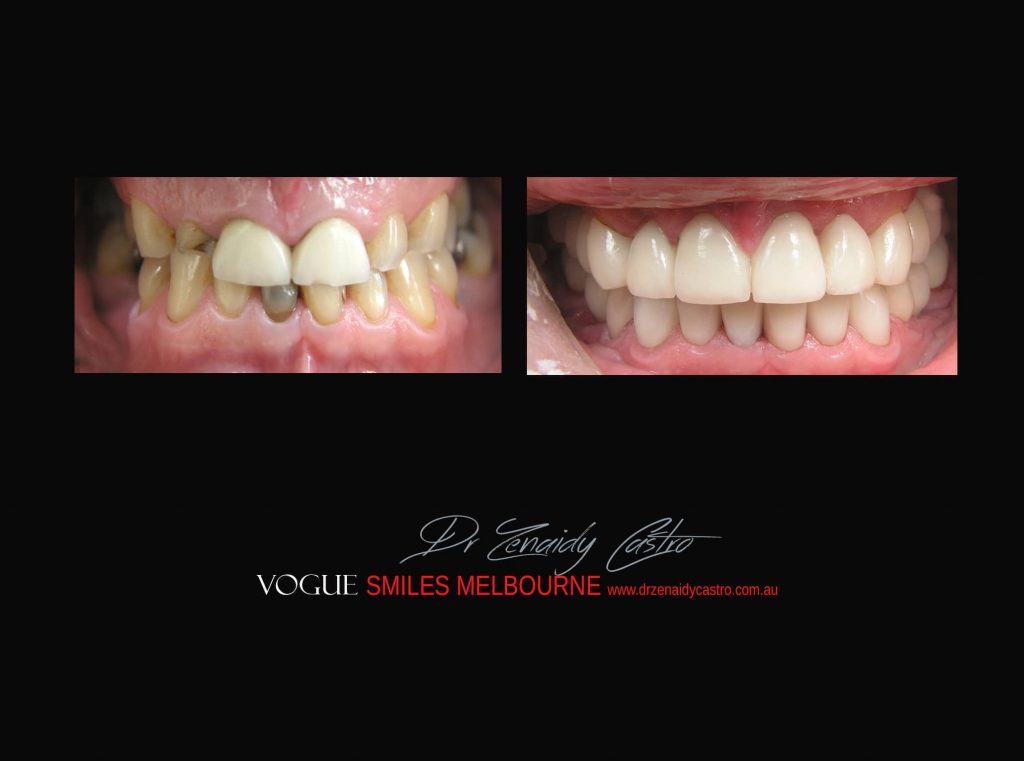 Top Cosmetic Dentist in Melbourne CBD before and after photo case study r13