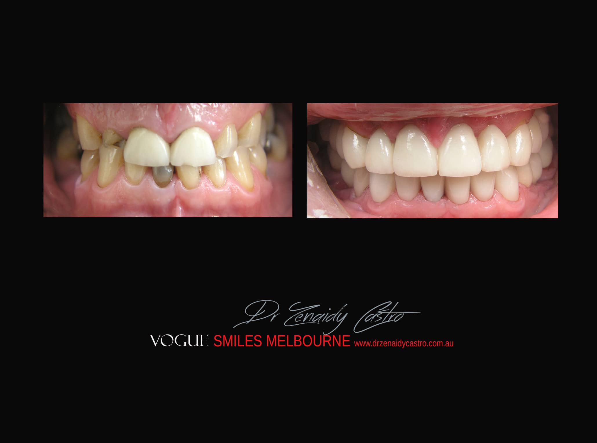 Top Cosmetic Dentist in Melbourne CBD before and after photo case study r13