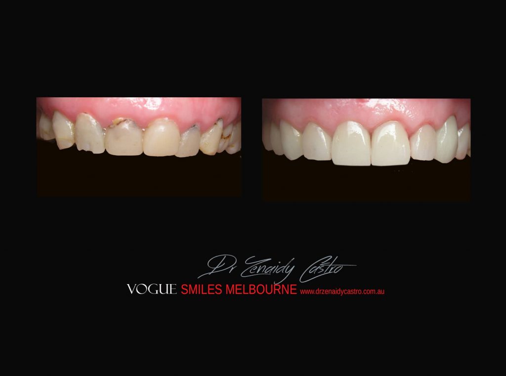 COSMETIC DENTIST MELBOURNE CASE STUDIES OF BEFORE AND AFTER- Top Cosmetic Dentist in Melbourne