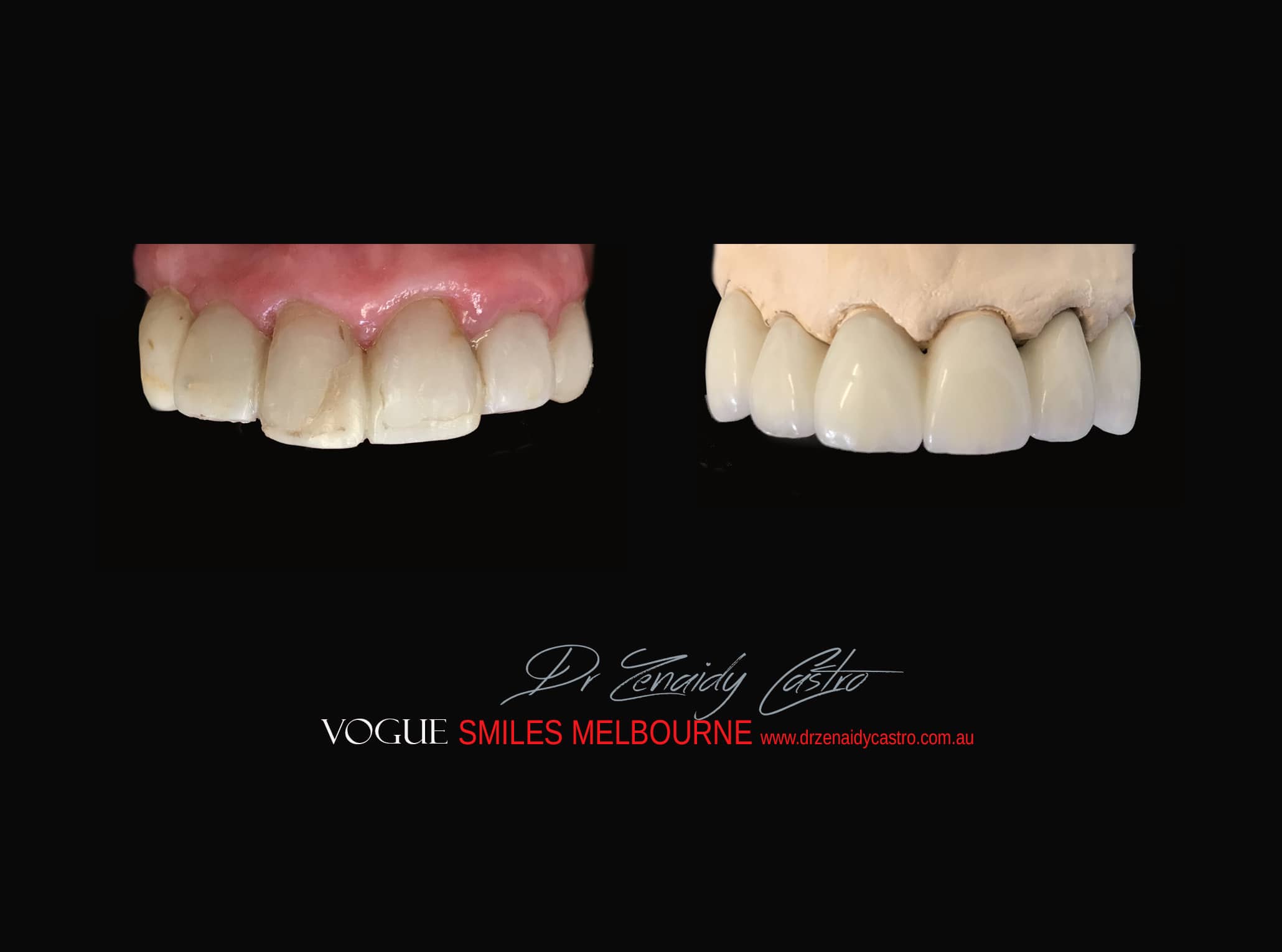 Top Cosmetic Dentist in Melbourne CBD before and after photo case study r11