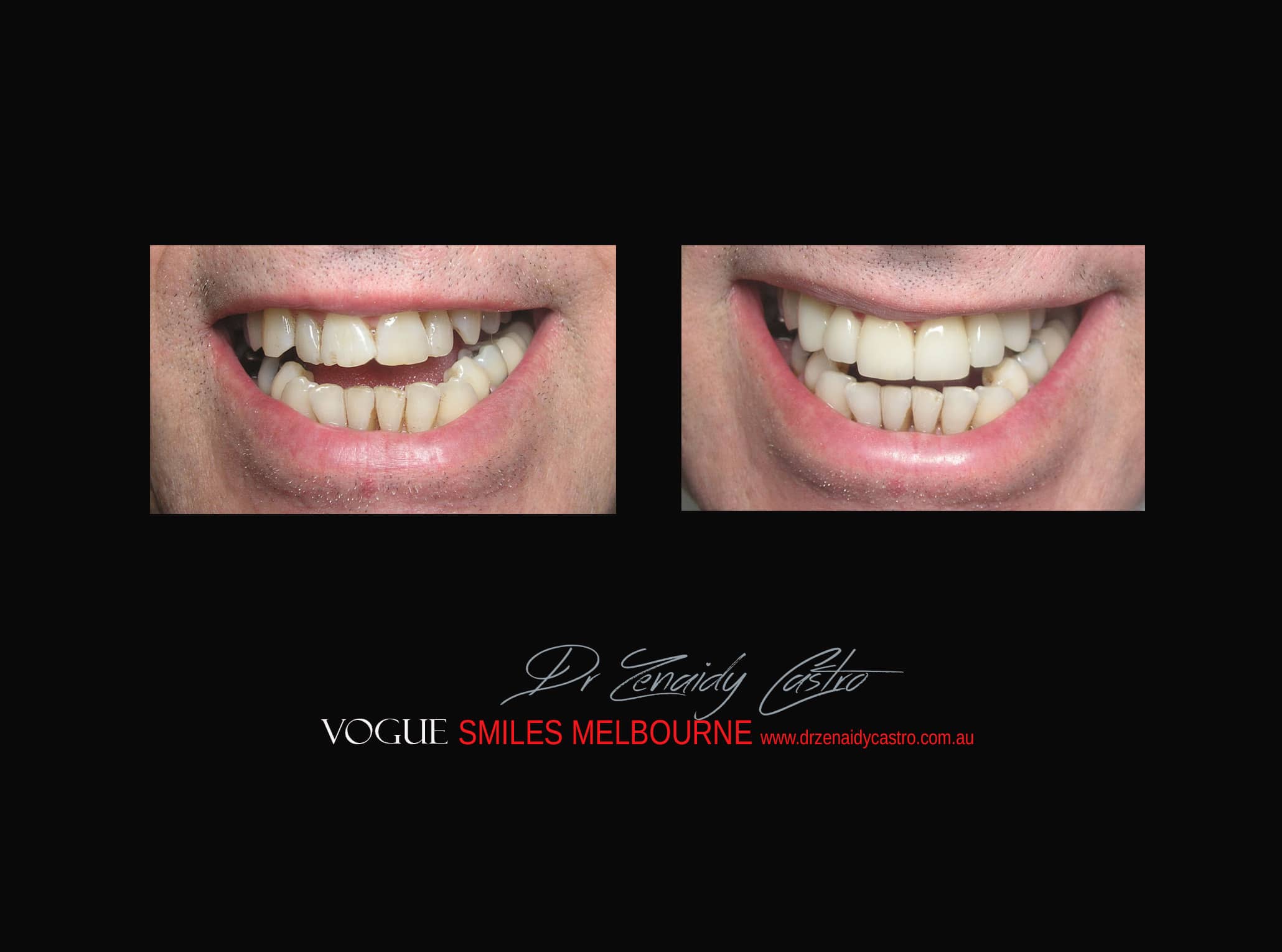 Top Cosmetic Dentist in Melbourne CBD before and after photo case study r10