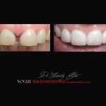 Top Cosmetic Dentist in Melbourne CBD before and after photo case study r75