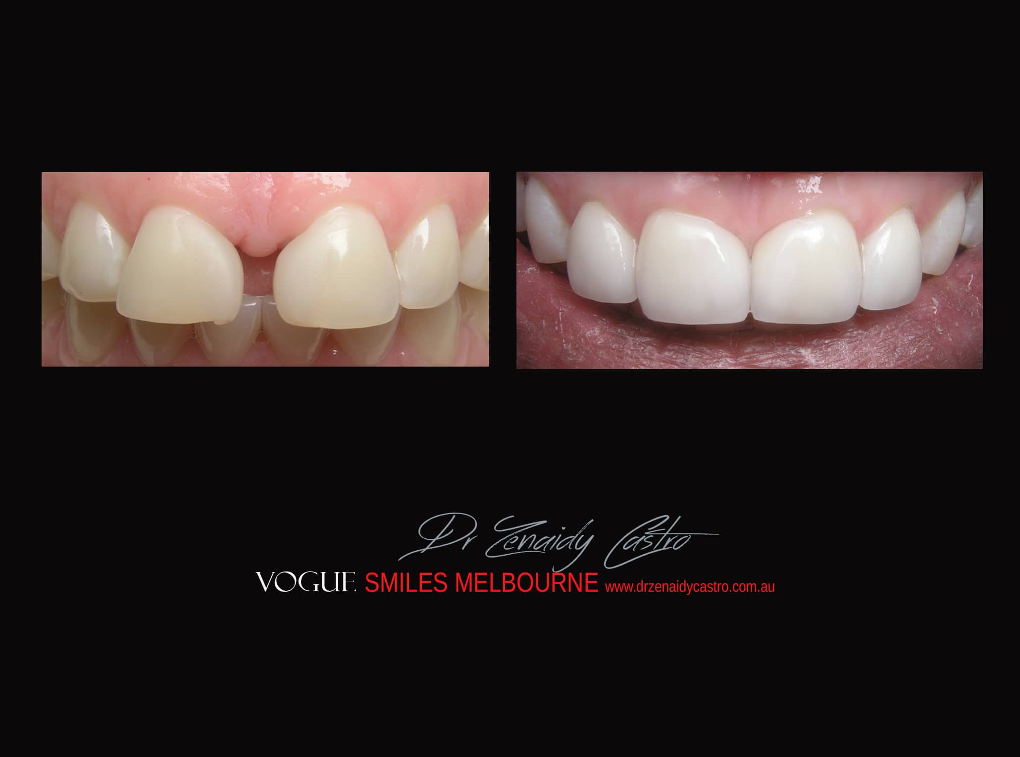 Top Cosmetic Dentist in Melbourne CBD before and after photo case study r75