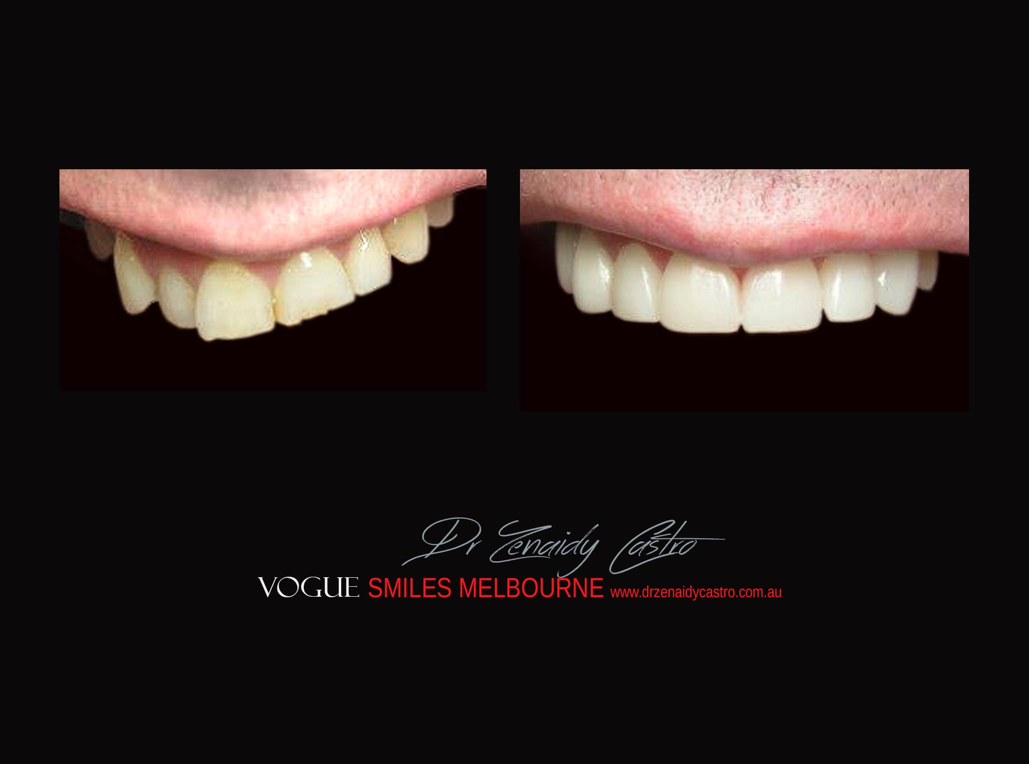 Top Cosmetic Dentist in Melbourne CBD before and after photo case study r74