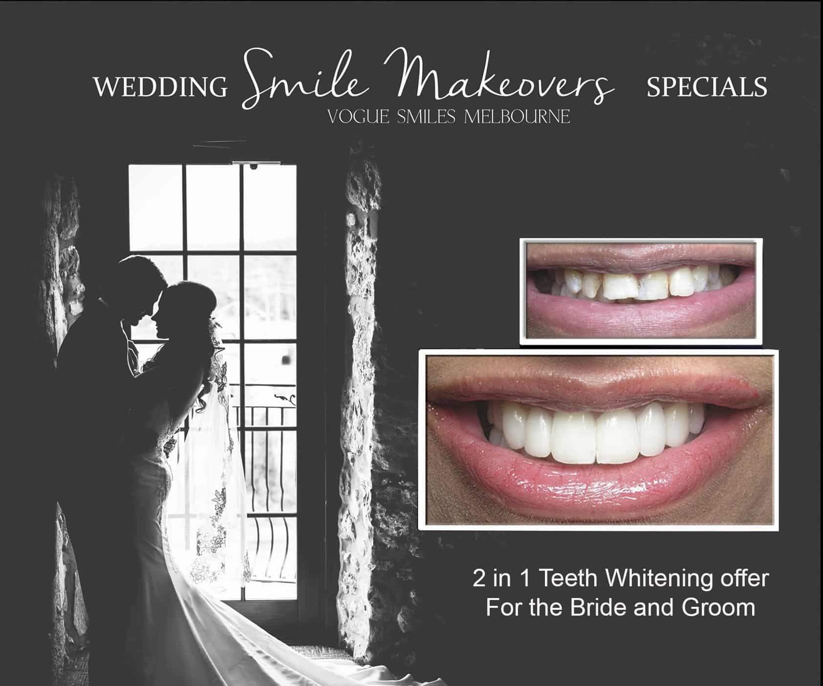 Bridal Smile Makeover-Dentist-Dr Zenaidy Castro Melbourne CBD