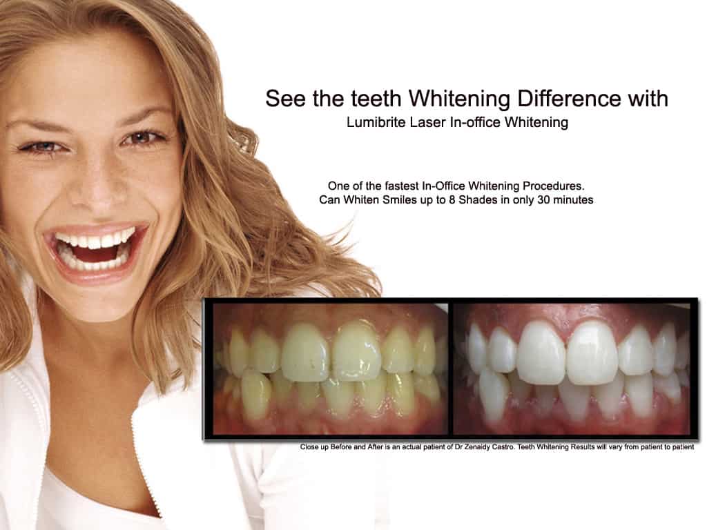 Laser Teeth Whitening- Dentist- MElbourne CBD-Dr Zenaidy Castro