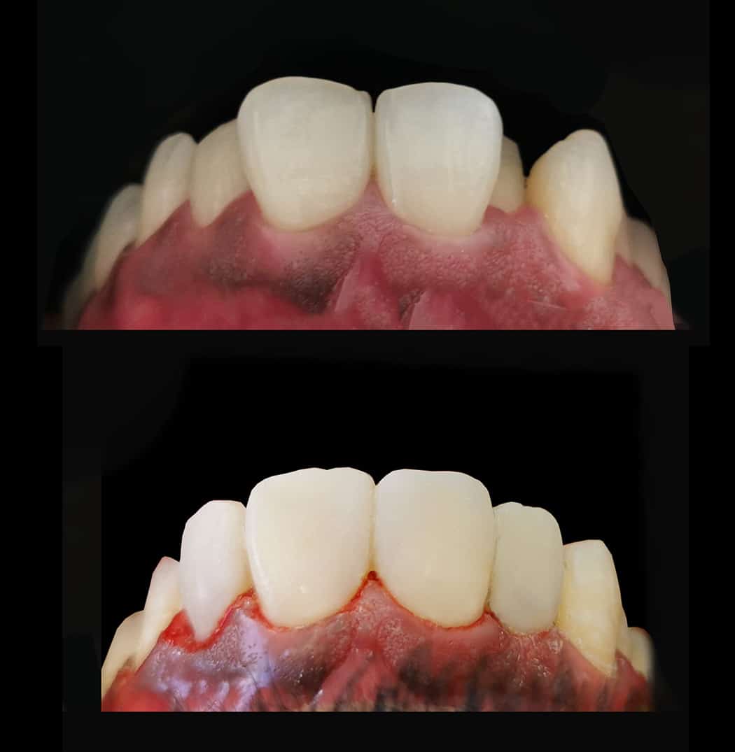 HOW MUCH DOES THE Cosmetic Dental Bonding or Composite Veneers COST IN MELBOURNE, Cost of Cosmetic Dental Bonding or Composite Veneers in Melbourne CBD?