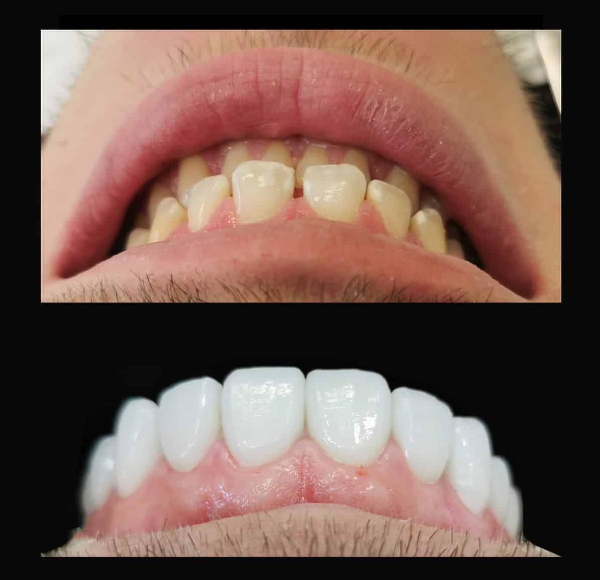 GAPS-OR-SPACING-BETWEEN-TEETH-BEFORE-AND-AFTER-V2