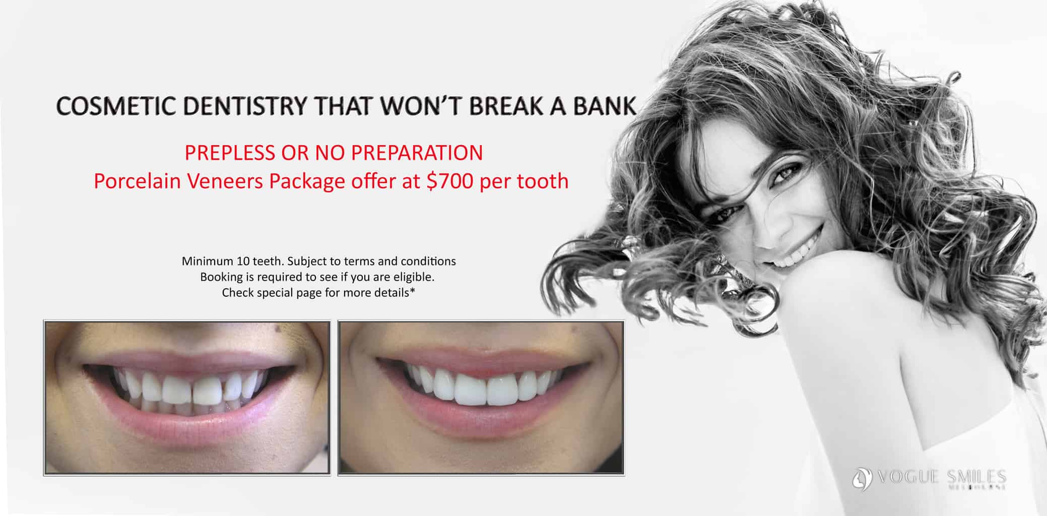 Veneers Melbourne Payment Plan