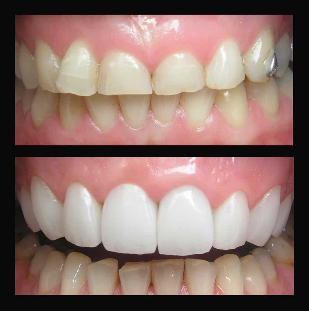 N0-PREP Porcelain Veneers - Dental Veneers without grinding teeth Melbourne