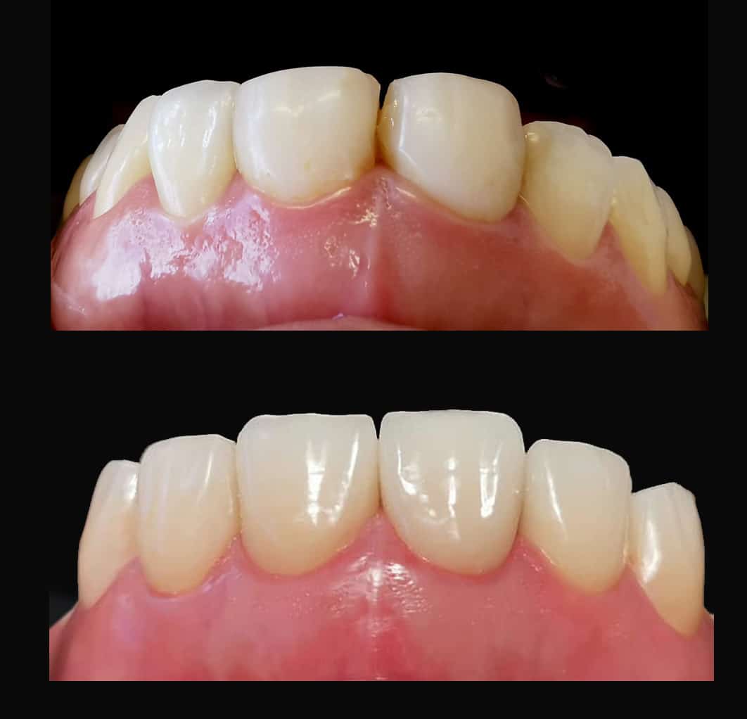 Porcelain veneers with No Grinding Down of Teeth, No-Prep, prepless Dental Veneers Melbourne CBD Best Cosmetic Porcelain Veneer dentist