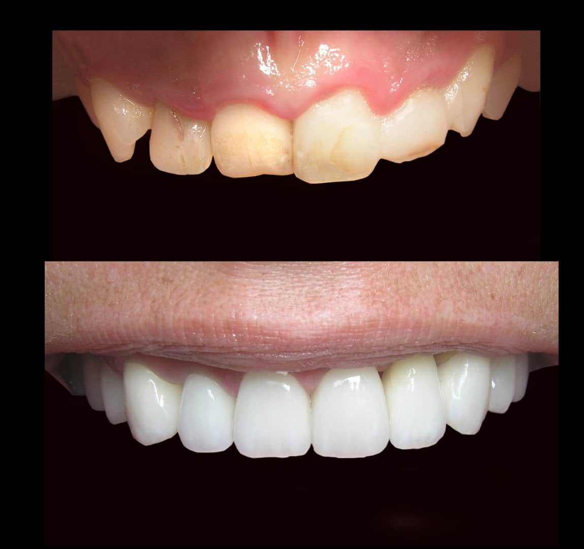 Porcelain veneers with No Grinding Down of Teeth, No-Prep, prepless Dental Veneers Melbourne CBD Best Cosmetic Porcelain Veneer dentist