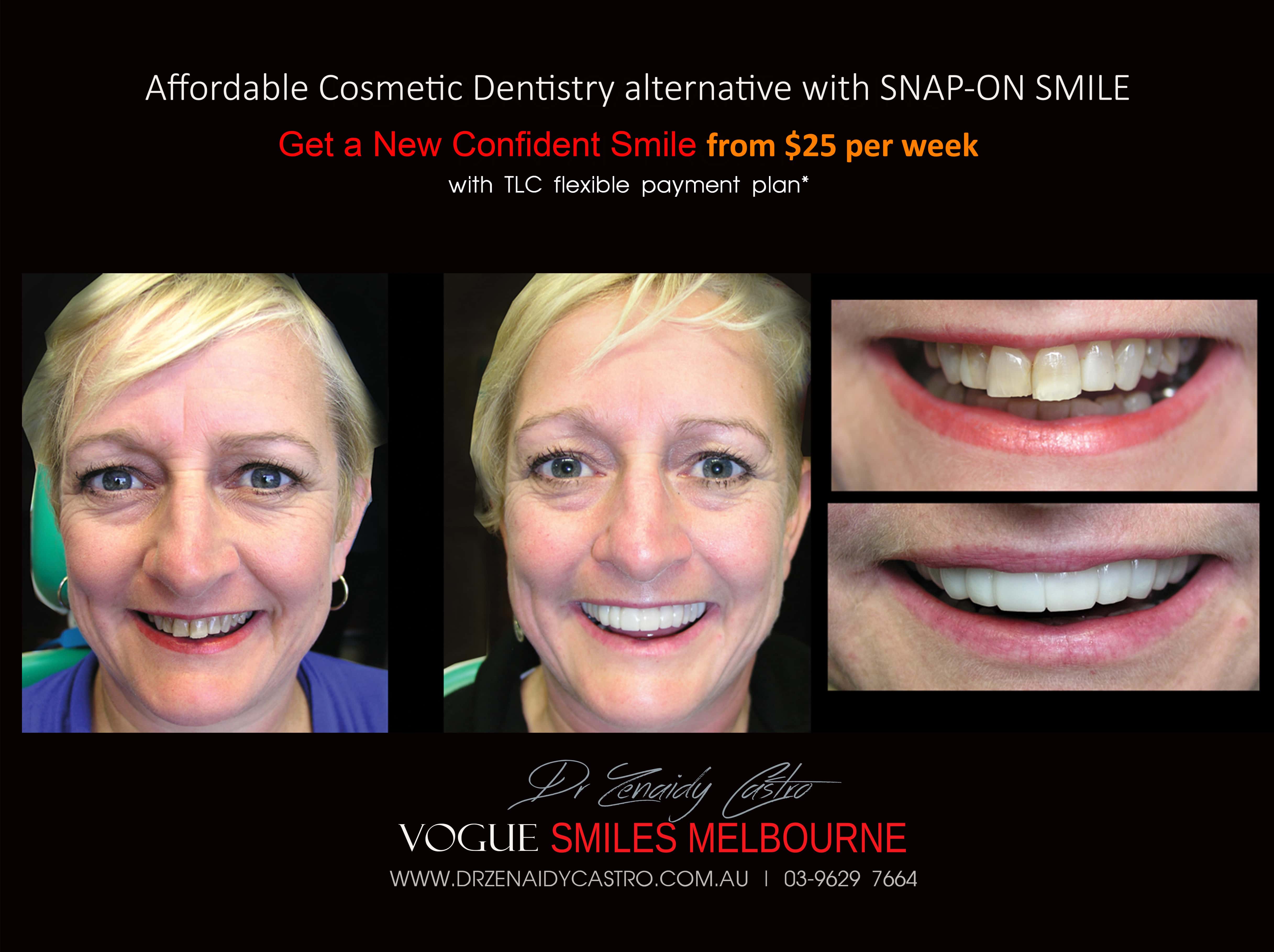 Smile Makeover Procedures Melbourne CBD Victoria Australia - Top Cosmetic Dentist Melbourne CBD - Dr Zenaidy Castro - VOGUE SMILES MELBOURNE