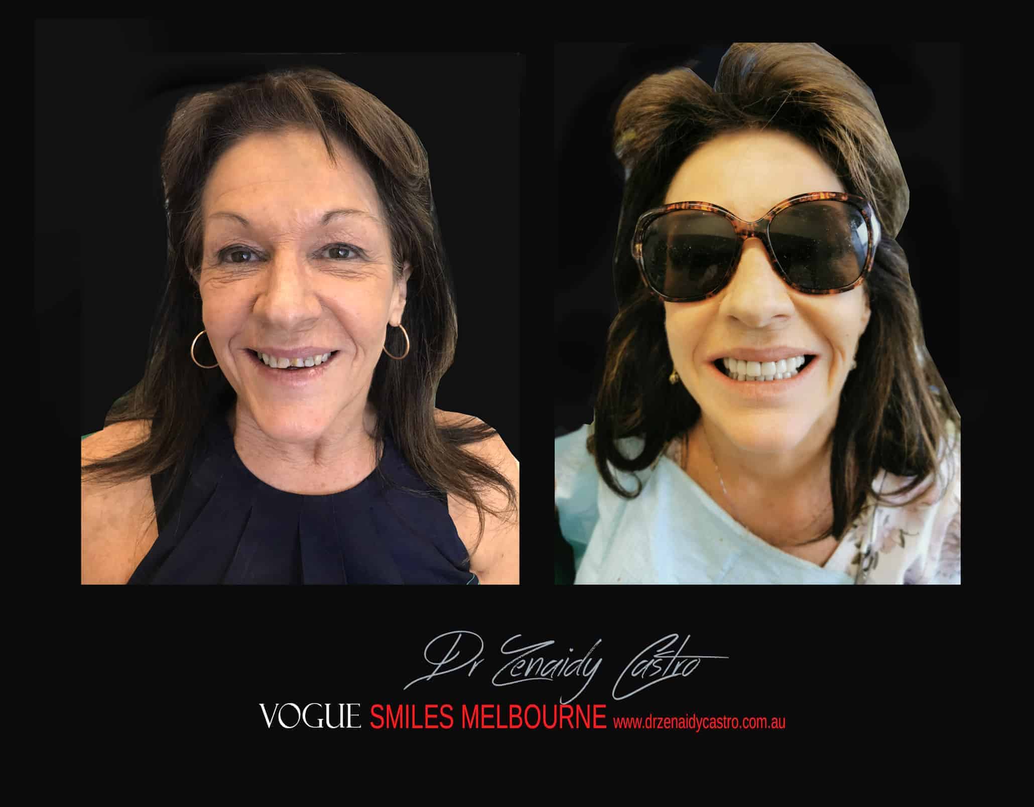 Non-surgical facelift procedure with Dental Veneers Melbourne CBD -Anti-aging expert Melbourne CBD, Non-Surgical & Minimally Invasive Facial and Smile Rejuvenation Melbourne