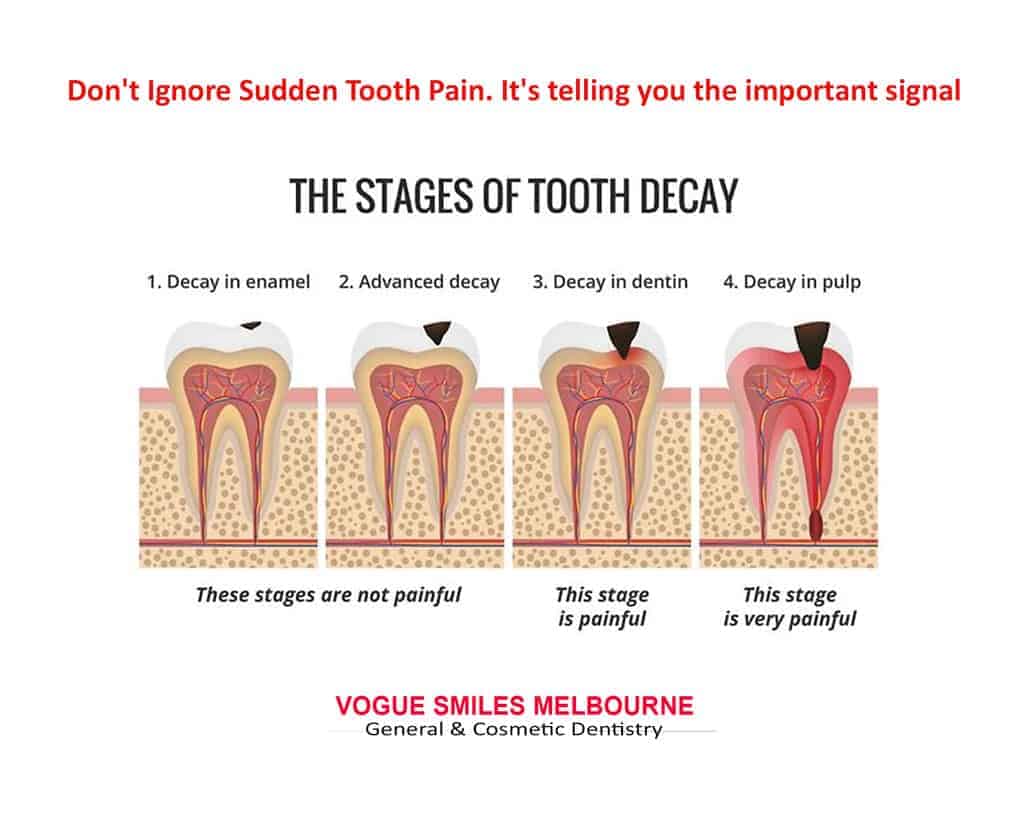 CAUSES-OF-SUDDEN-TOOTH-PAIN-TOOTHACHE--STAGES-OF-TOOTH-DECAY DENTIST IN MELBOURNE CBD
