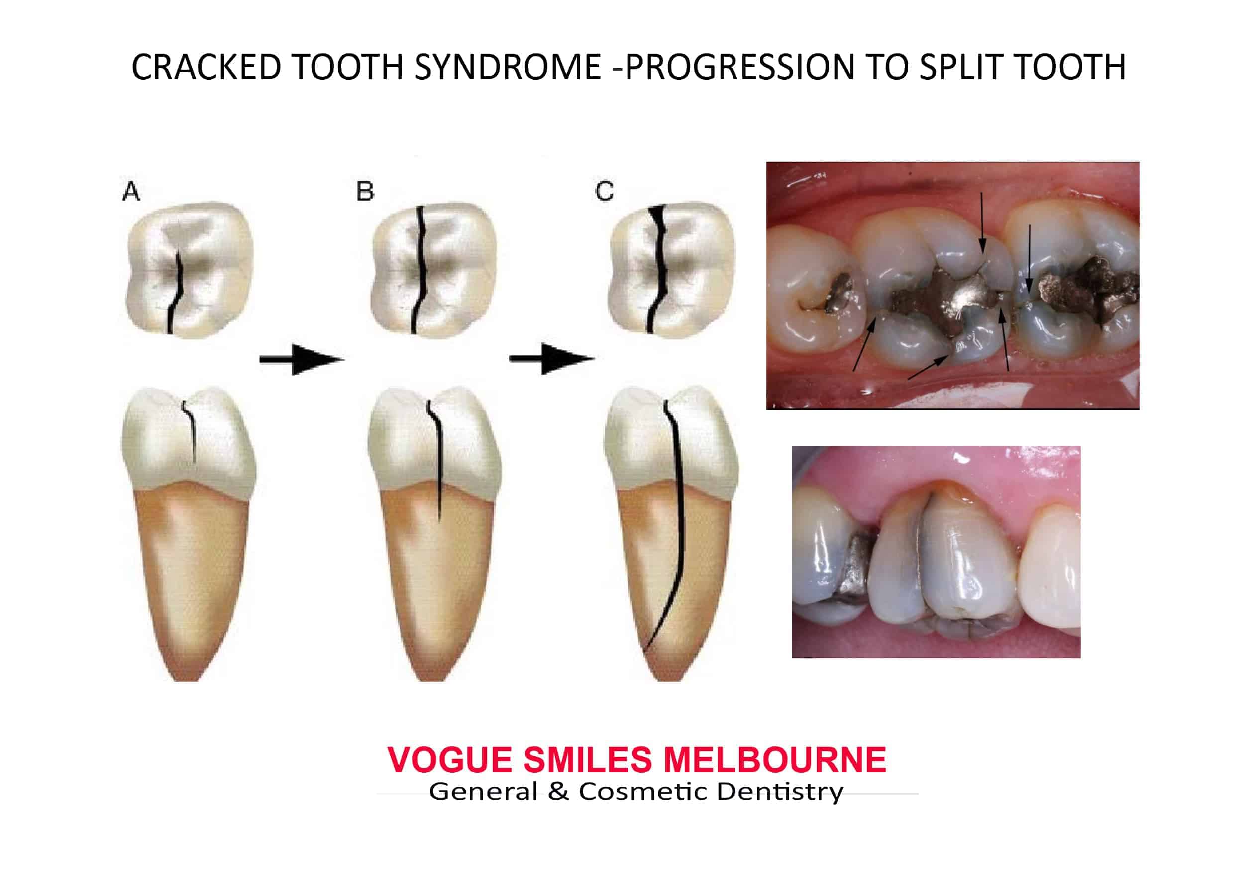 CRACKED TOOTH SYNDROME -CRACKED MOLAR DENTIST MELBOURNE